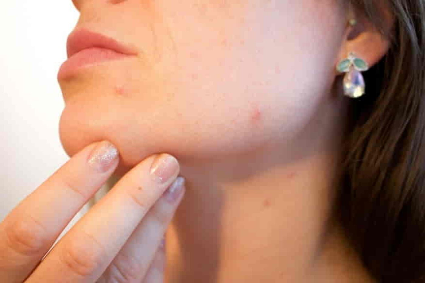 Tretinoin for Blackheads